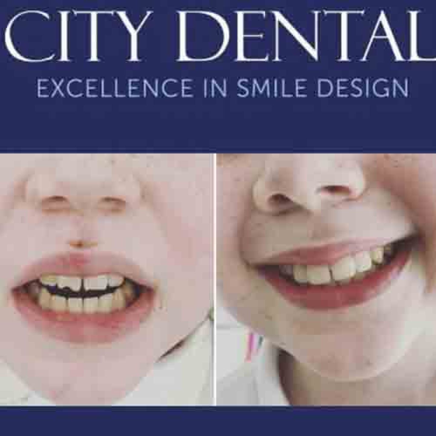 Composite Bonding Gallery Composite Bonding Gallery